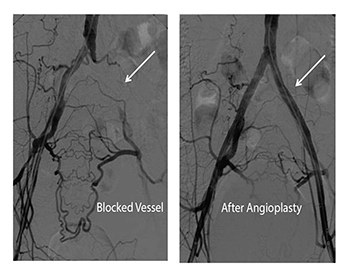 Iliac artery Angioplasty and Stenting